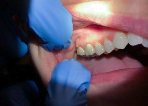 Best Emergency Dental Care for Broken or Chipped Teeth in Lamont, CA
